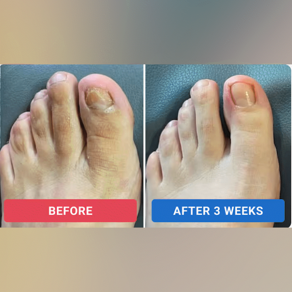 FungalFix™ - Fungal Nail Renewal Patches