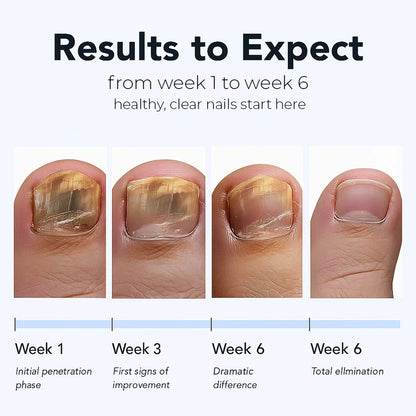 FungalFix™ - Fungal Nail Renewal Patches
